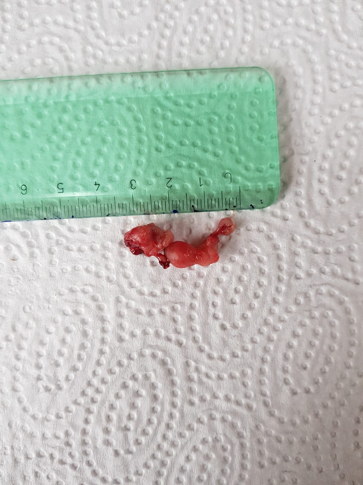 Polyp
